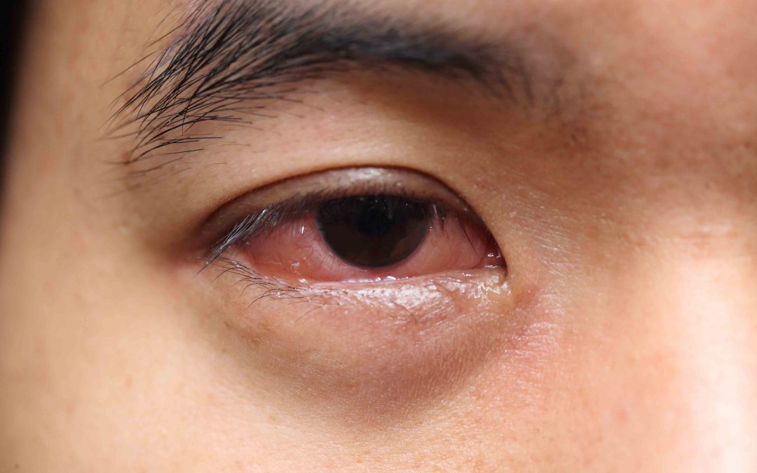 ¿Qué es la Conjuntivitis?